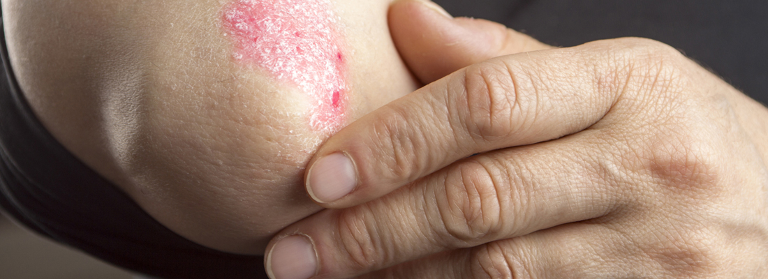 psoriasis sans ordonnance